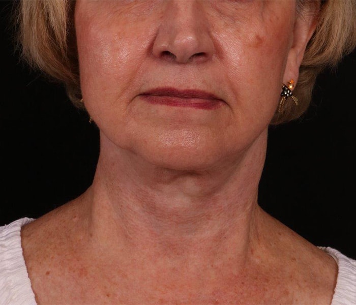 After Image: Facelift - front
