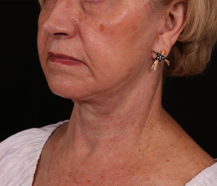 after Facelift surgery Austin TX