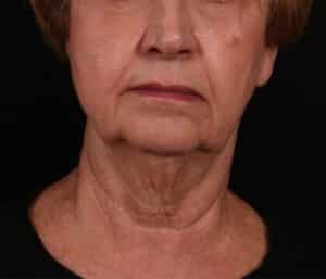 Before Image: Facelift