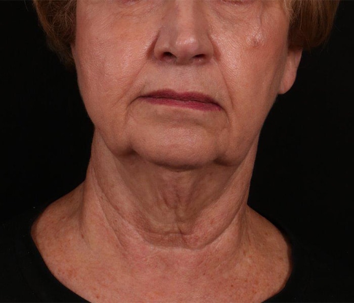 Before Image: Facelift - front