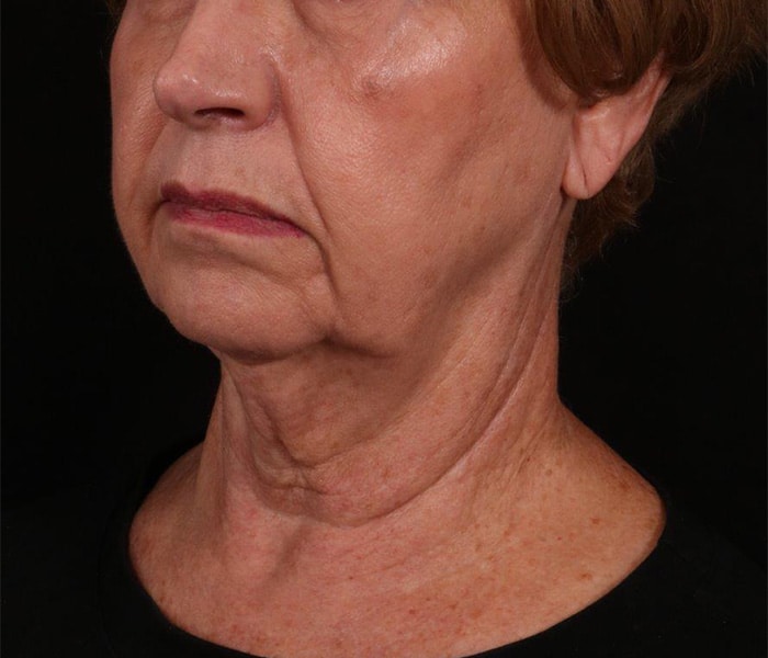 before Facelift surgery Austin TX
