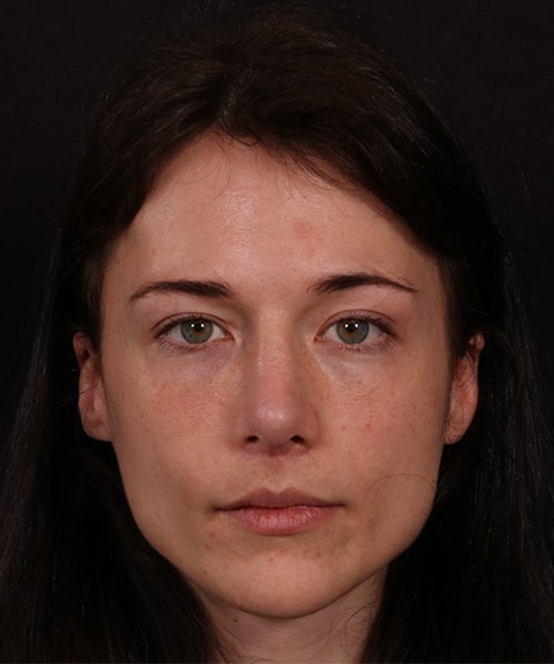 After Image: Revision Rhinoplasty -