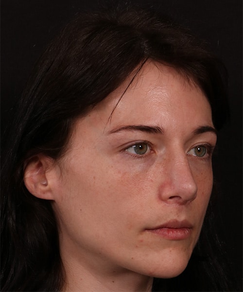 After Image: Revision Rhinoplasty - right-front-oblique