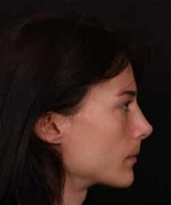 After Image: Revision Rhinoplasty