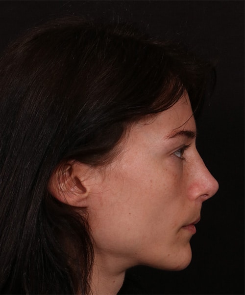 After Image: Revision Rhinoplasty - right-side