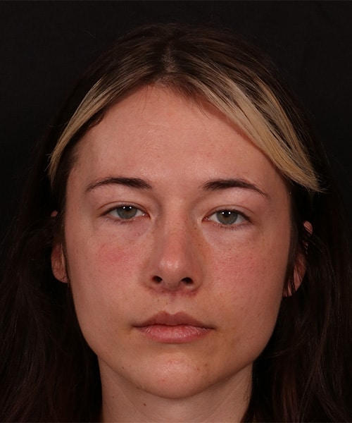 Before Image: Revision Rhinoplasty -