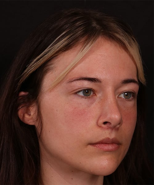 Before Image: Revision Rhinoplasty - right-front-oblique