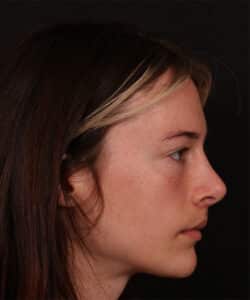 Before Image: Revision Rhinoplasty