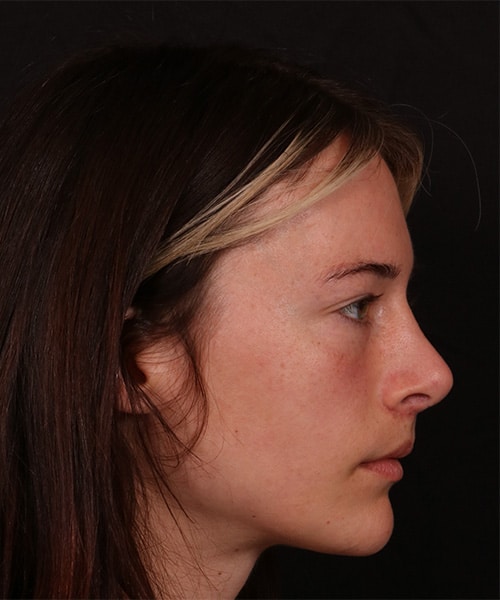 Before Image: Revision Rhinoplasty - right-side