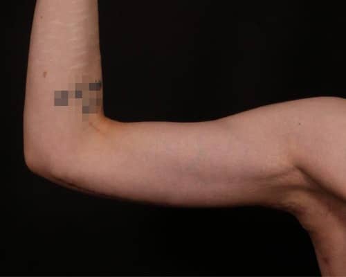 After Image: Brachioplasty (Arm Lift) - front