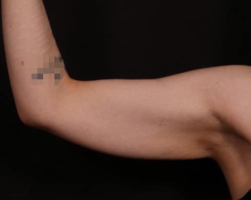 Before Image: Brachioplasty (Arm Lift) - front