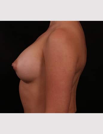 After Image: Breast Augmentation - left-side