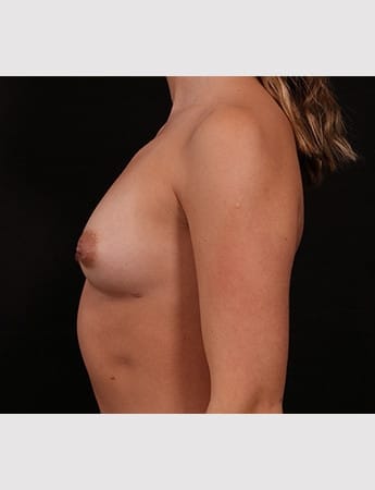 Before Image: Breast Augmentation - left-side