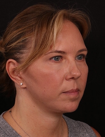 After Image: Lower Facelift - right-front-oblique