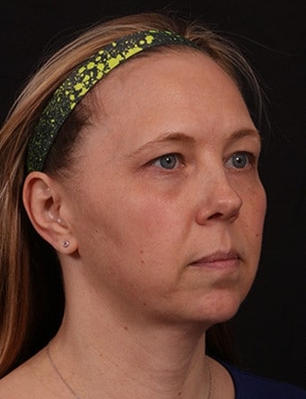 Before Image: Lower Facelift - right-front-oblique