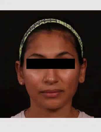 After Image: Otoplasty - front