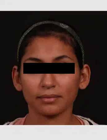 Before Image: Otoplasty - front
