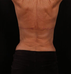 After Image: Bra Strap Excision