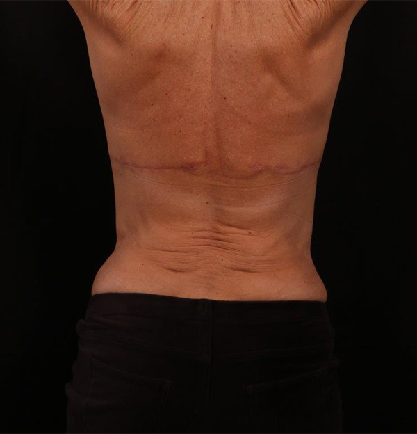 After Image: Bra Strap Excision - back