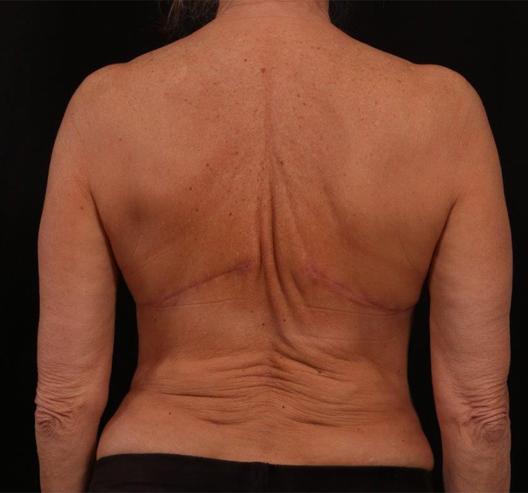 After Image: Bra Strap Excision - back