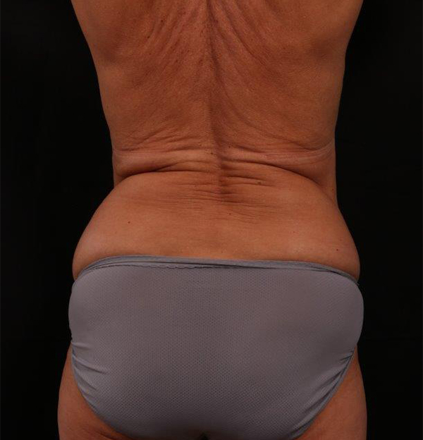 Before Image: Bra Strap Excision - back