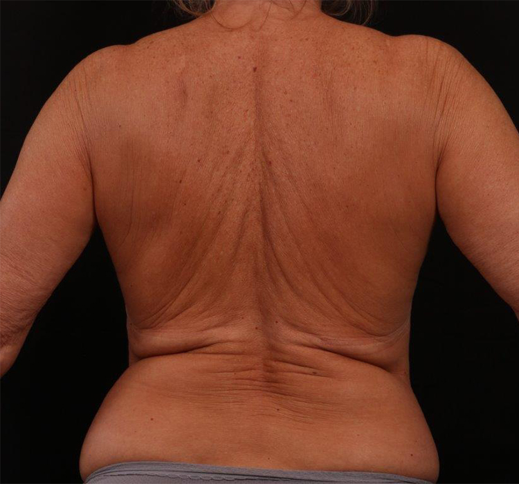 Before Image: Bra Strap Excision - back