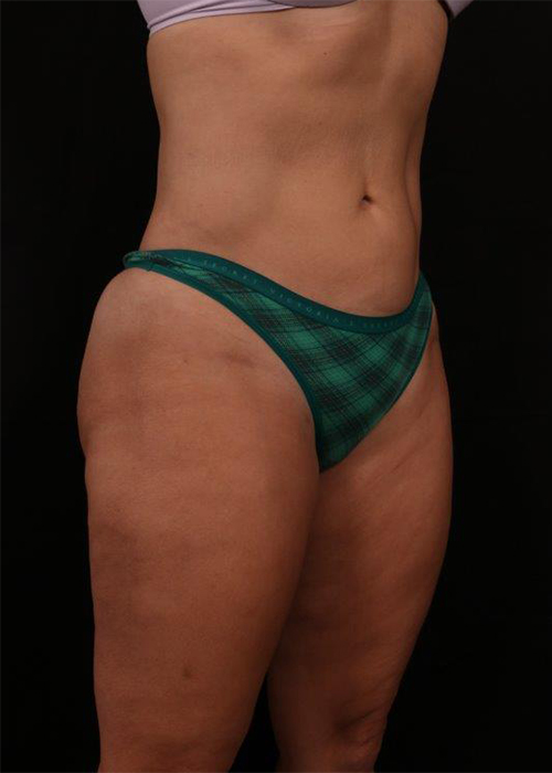After Image: Liposuction - right-front-oblique