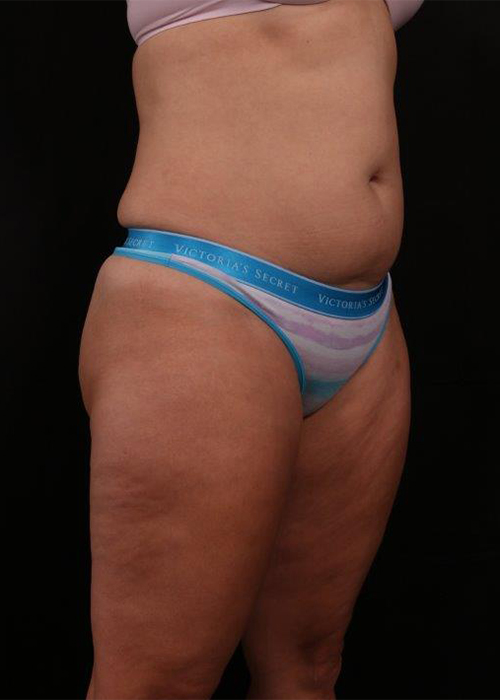 Before Image: Liposuction - right-front-oblique