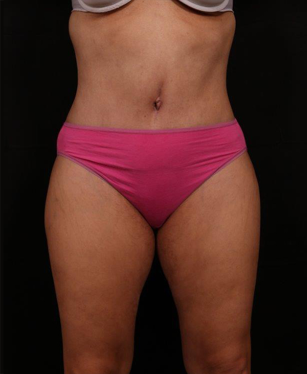 After Image: Tummy Tuck (Abdominoplasty) With Liposuction - front