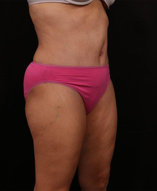After Image: Tummy Tuck (Abdominoplasty) With Liposuction - right-front-oblique