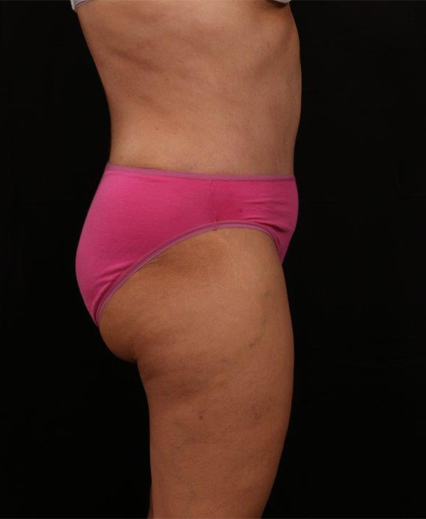 After Image: Tummy Tuck (Abdominoplasty) With Liposuction - right-side