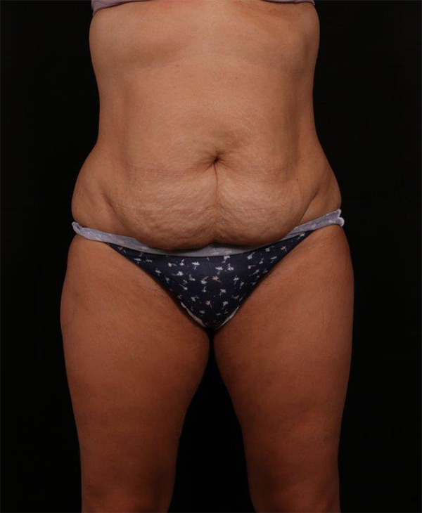 Before Image: Tummy Tuck (Abdominoplasty) With Liposuction - front