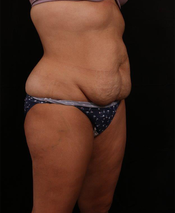 Before Image: Tummy Tuck (Abdominoplasty) With Liposuction - right-front-oblique