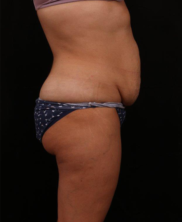 Before Image: Tummy Tuck (Abdominoplasty) With Liposuction - right-side