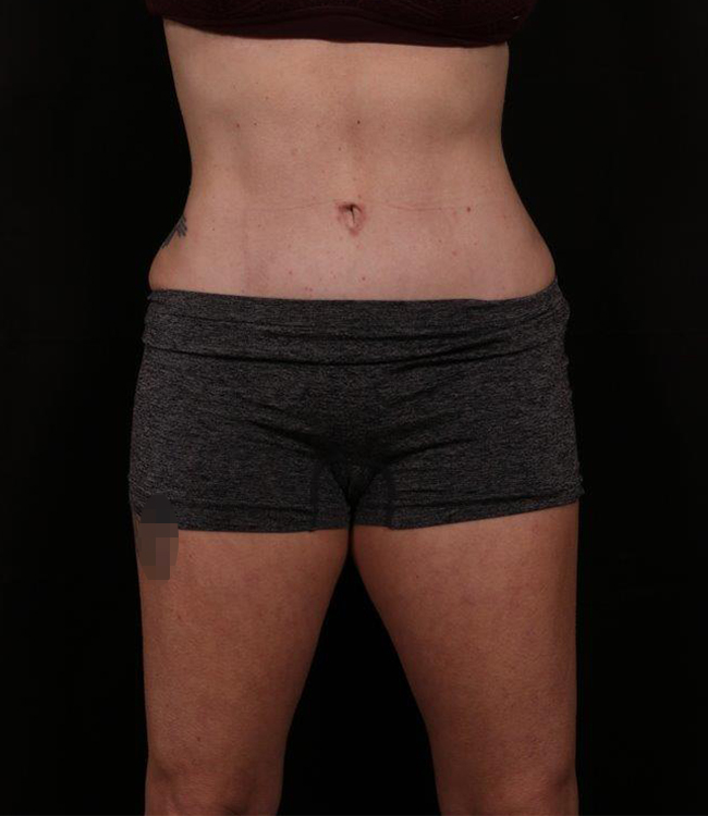 Tummy Tuck (Abdominoplasty) With Liposuction
