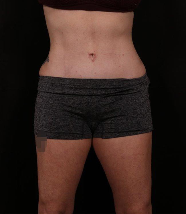 After Image: Tummy Tuck (Abdominoplasty) With Liposuction - front