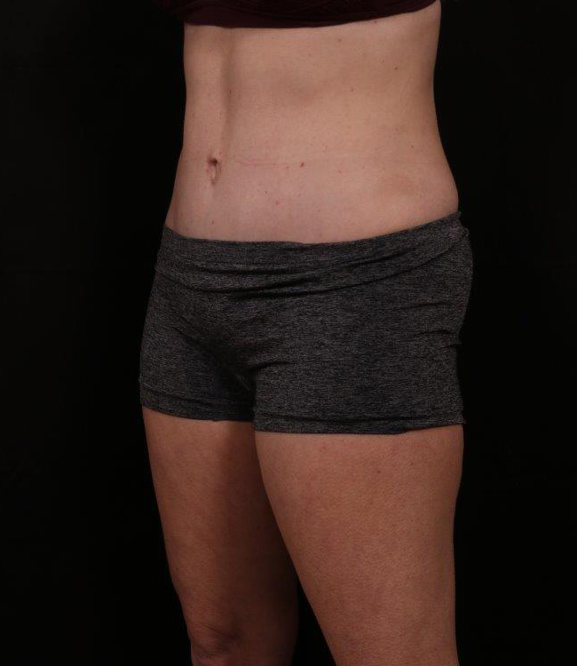 After Image: Tummy Tuck (Abdominoplasty) With Liposuction - left-front-oblique