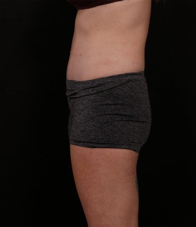 After Image: Tummy Tuck (Abdominoplasty) With Liposuction - left-side