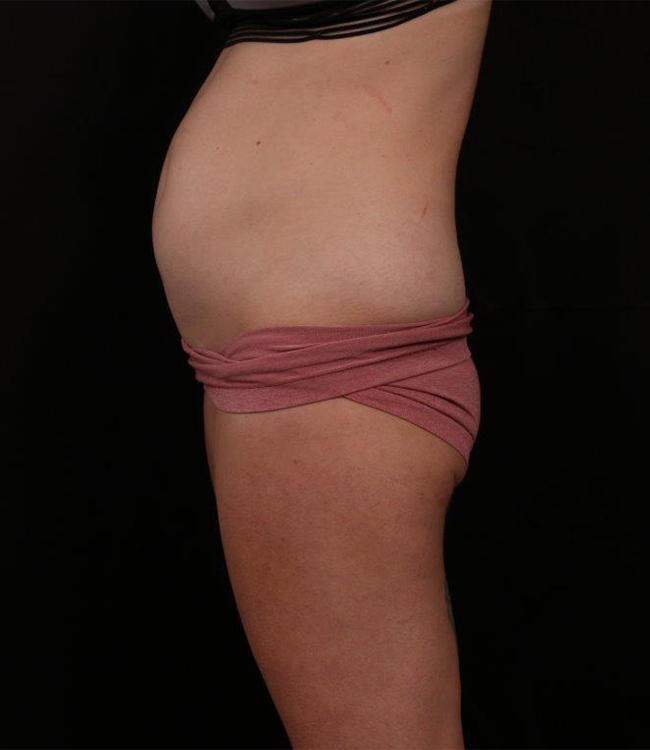 Before Image: Tummy Tuck (Abdominoplasty) With Liposuction - left-side
