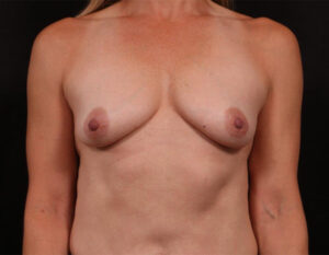 Before Image: Breast Lift With Augmentation