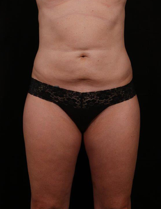 Before Image: Tummy Tuck (Abdominoplasty) - front