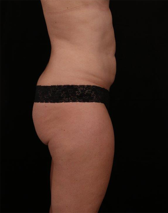 Before Image: Tummy Tuck (Abdominoplasty) - right-side