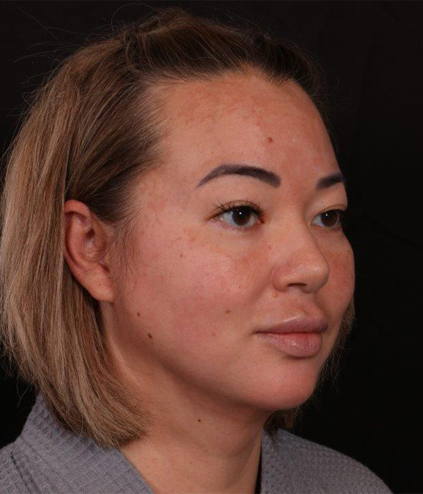 After Image: Buccal Fat Removal and Neck Lipo - right-front-oblique