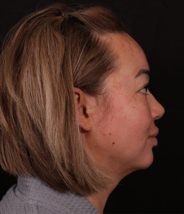 After Image: Buccal Fat Removal and Neck Lipo - right-side