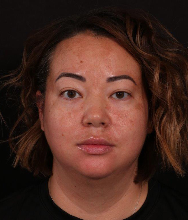 Before Image: Buccal Fat Removal and Neck Lipo - front