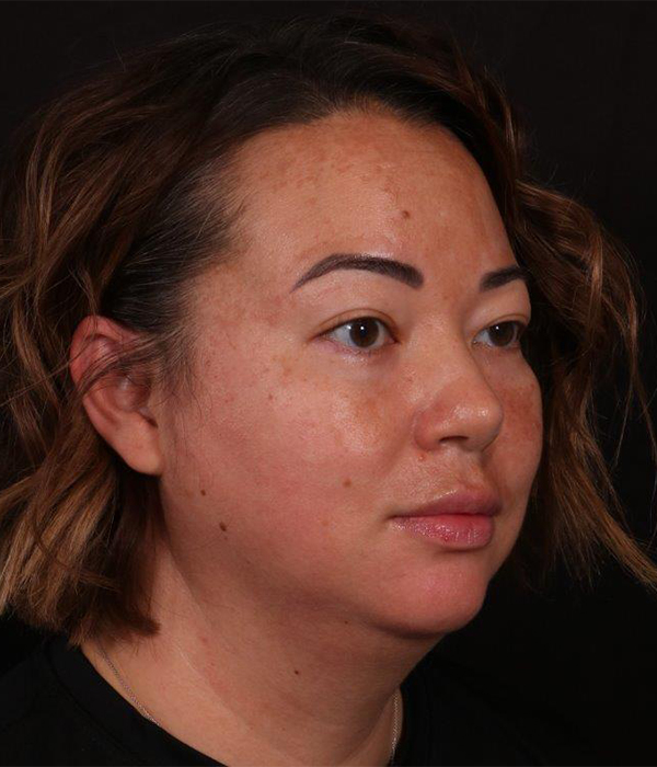 Before Image: Buccal Fat Removal and Neck Lipo - right-front-oblique