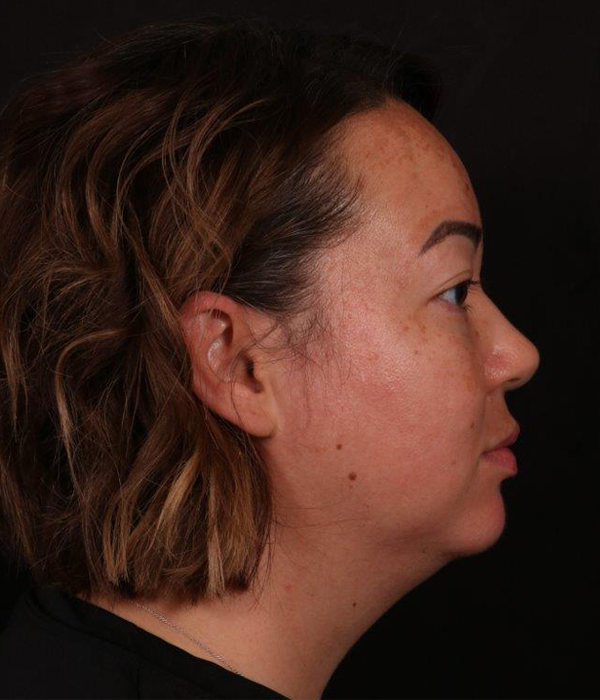 Before Image: Buccal Fat Removal and Neck Lipo - right-side