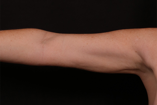 After Image: Arm Liposuction - front
