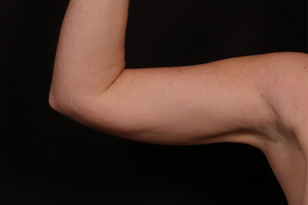 After Image: Arm Liposuction - front