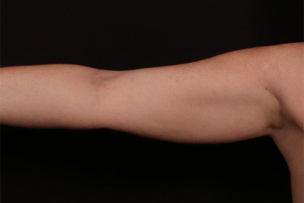 Before Image: Arm Liposuction - front